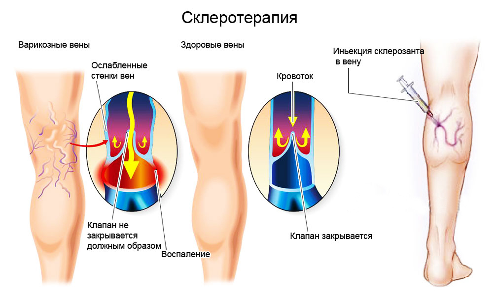 лечение варикоза днепр