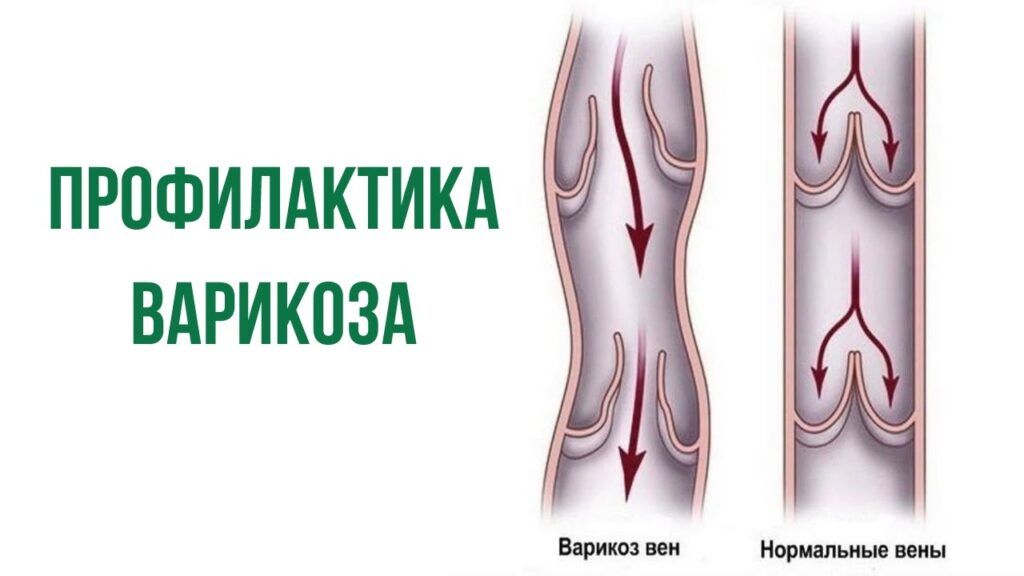 профилактика варикоза