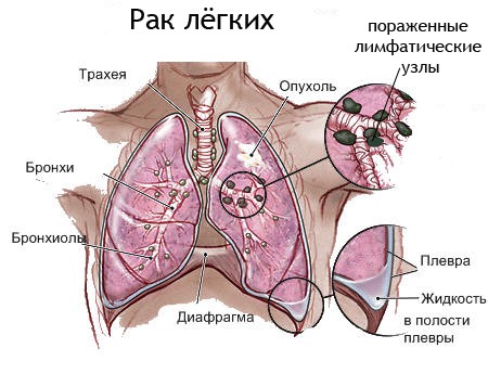 варианты лечения рака легких