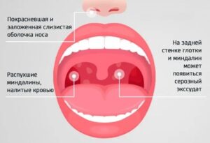 фарингит симптомы