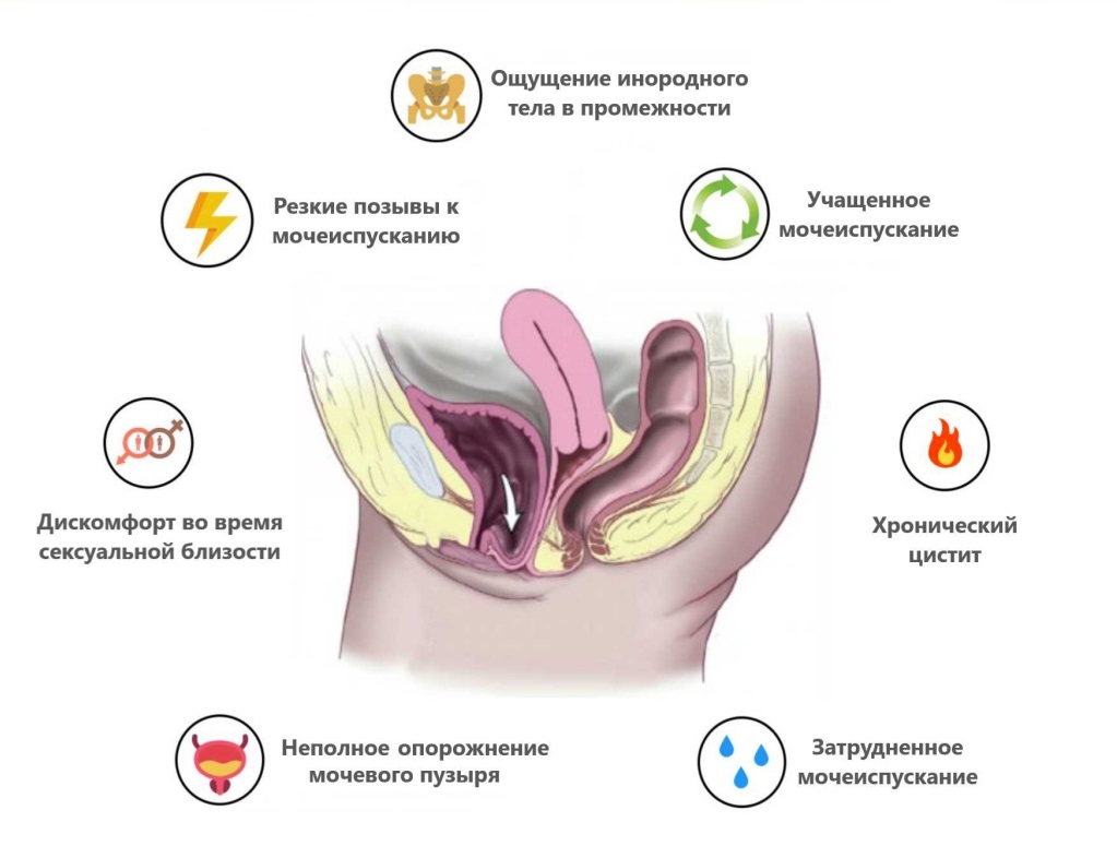 симптомы цистита