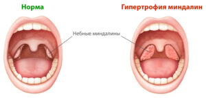 аденоиды