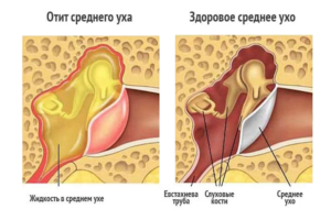 отит
