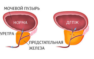 аденома простаты